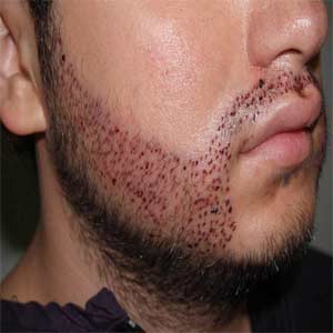 کاشت   ریش  و سبیل